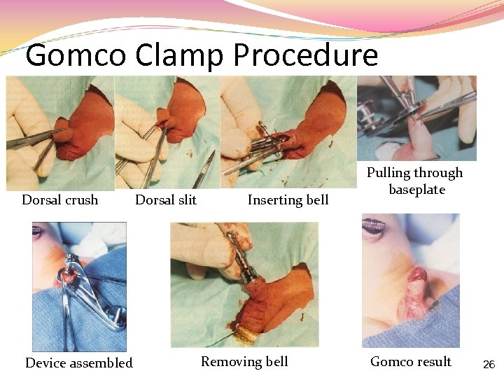 Gomco Clamp Procedure Dorsal crush Device assembled Dorsal slit Inserting bell Removing bell Pulling