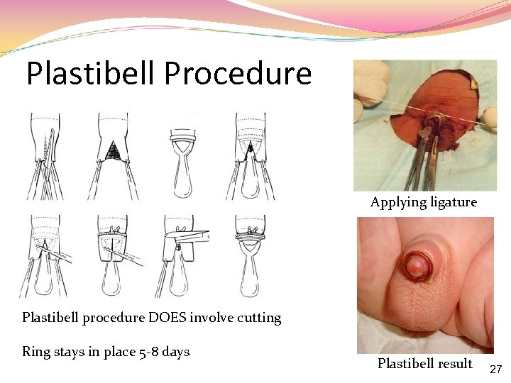 Plastibell Procedure Applying ligature Plastibell procedure DOES involve cutting Ring stays in place 5