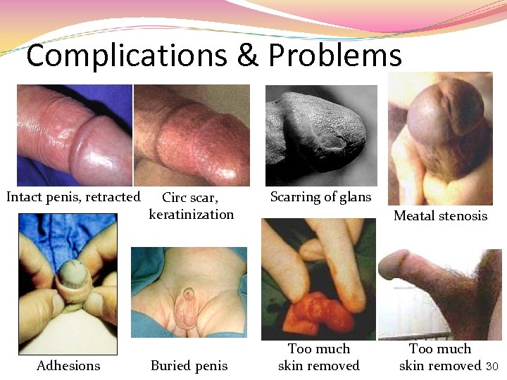 Complications & Problems Intact penis, retracted Adhesions Circ scar, keratinization Buried penis Scarring of