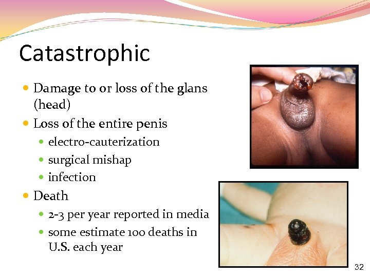 Catastrophic Damage to or loss of the glans (head) Loss of the entire penis