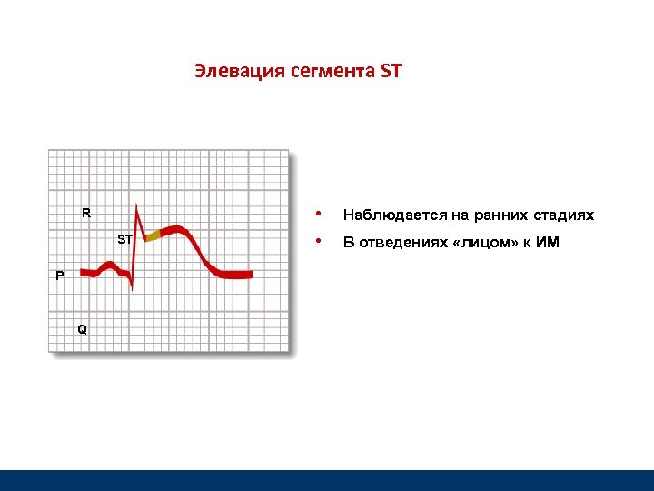 Элевация сегмента ST R ST P Q • • Наблюдается на ранних стадиях В