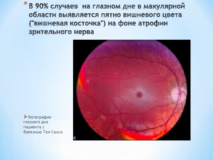 Презентация синдром тея сакса