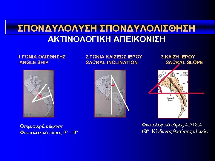 ΣΠΟΝΔΥΛΟΛYΣΗ ΣΠΟΝΔΥΛΟΛΙΣΘΗΣΗ ΑΚΤΙΝΟΛΟΓΙΚΗ ΑΠΕΙΚΟΝΙΣΗ 1. ΓΩΝΙΑ ΟΛΙΣΘΗΣΗΣ ANGLE SHIP Οσφυοιερά κύφωση Φυσιολογικό εύρος 0º