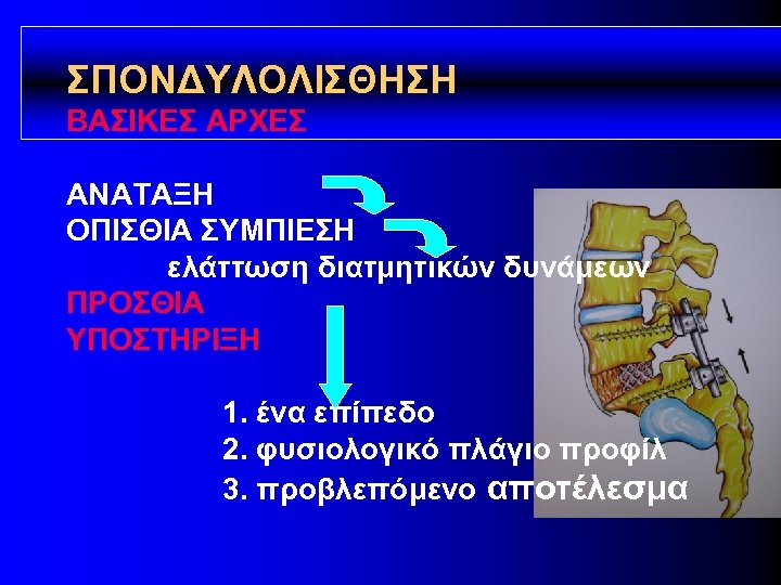 ΣΠΟΝΔΥΛΟΛΙΣΘΗΣΗ ΒΑΣΙΚΕΣ ΑΡΧΕΣ ΑΝΑΤΑΞΗ ΟΠΙΣΘΙΑ ΣΥΜΠΙΕΣΗ ελάττωση διατμητικών δυνάμεων ΠΡΟΣΘΙΑ ΥΠΟΣΤΗΡΙΞΗ 1. ένα επίπεδο