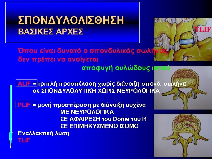 ΣΠΟΝΔΥΛΟΛΙΣΘΗΣΗ ΒΑΣΙΚΕΣ ΑΡΧΕΣ Όπου είναι δυνατό ο σπονδυλικός σωλήνας δεν πρέπει να ανοίγεται αποφυγή