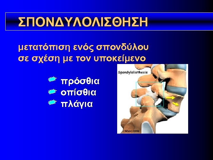 ΣΠΟΝΔΥΛΟΛΙΣΘΗΣΗ μετατόπιση ενός σπονδύλου σε σχέση με τον υποκείμενο πρόσθια οπίσθια πλάγια 