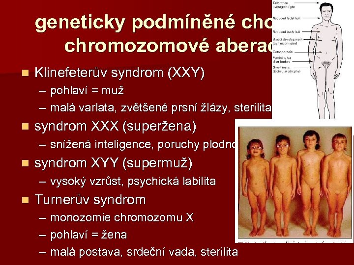 geneticky podmíněné choroby chromozomové aberace n Klinefeterův syndrom (XXY) – pohlaví = muž –
