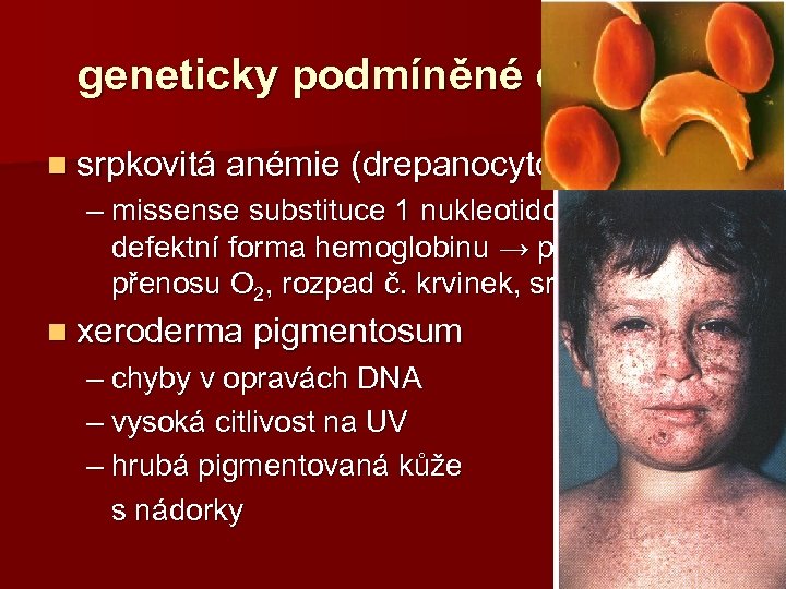 geneticky podmíněné choroby n srpkovitá anémie (drepanocytóza) – missense substituce 1 nukleotidového páru →