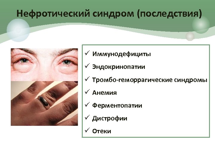 Нефротический синдром (последствия) ü Иммунодефициты ü Эндокринопатии ü Тромбо-геморрагические синдромы ü Анемия ü Ферментопатии