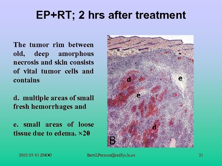 EP+RT; 2 hrs after treatment The tumor rim between old, deep amorphous necrosis and