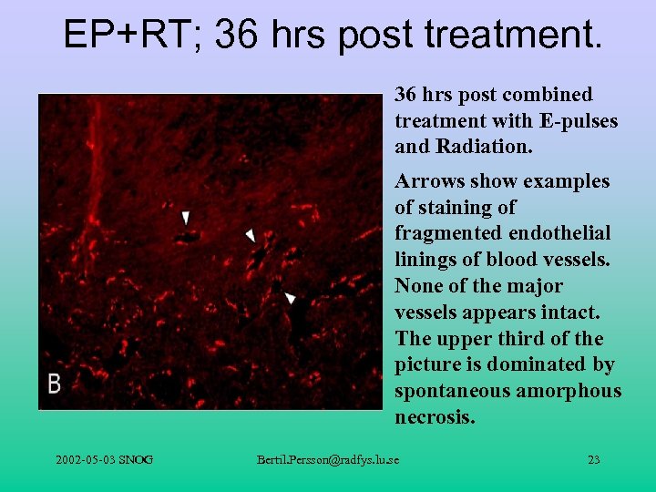 EP+RT; 36 hrs post treatment. 36 hrs post combined treatment with E-pulses and Radiation.
