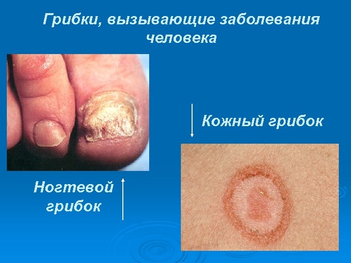 Грибки, вызывающие заболевания человека Кожный грибок Ногтевой грибок 