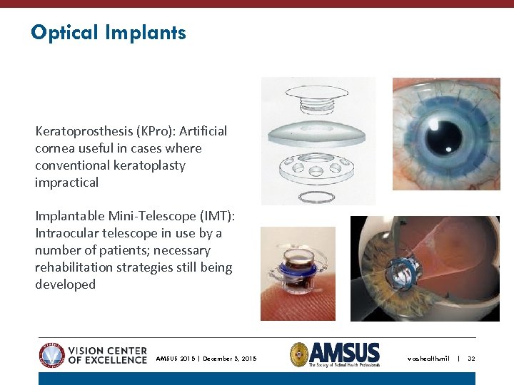Optical Implants Keratoprosthesis (KPro): Artificial cornea useful in cases where conventional keratoplasty impractical Implantable