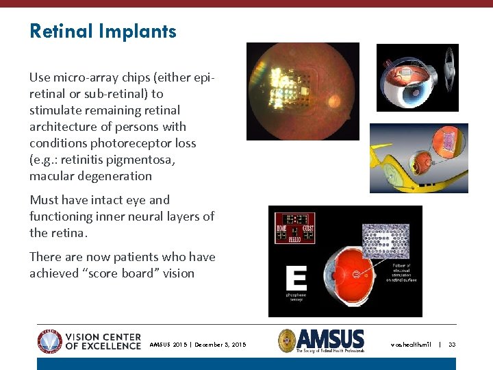 Retinal Implants Use micro-array chips (either epiretinal or sub-retinal) to stimulate remaining retinal architecture