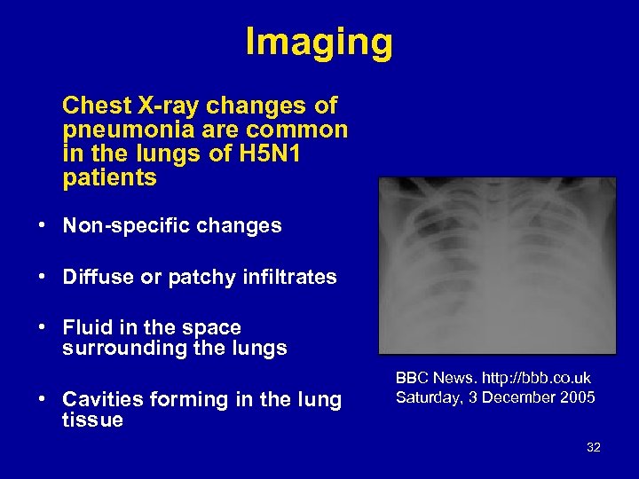 Imaging Chest X-ray changes of pneumonia are common in the lungs of H 5