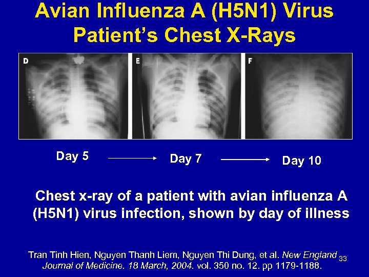 Avian Influenza A (H 5 N 1) Virus Patient’s Chest X-Rays Day 5 Day