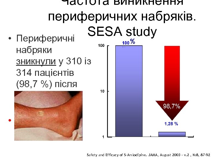  • Частота виникнення периферичних набряків. SESA study Периферичні набряки зникнули у 310 із