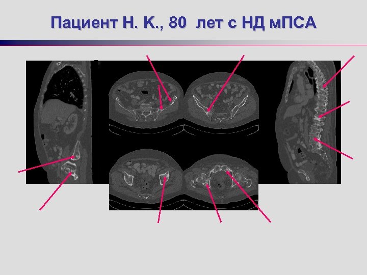 Пациент H. K. , 80 лет с НД м. ПСА 