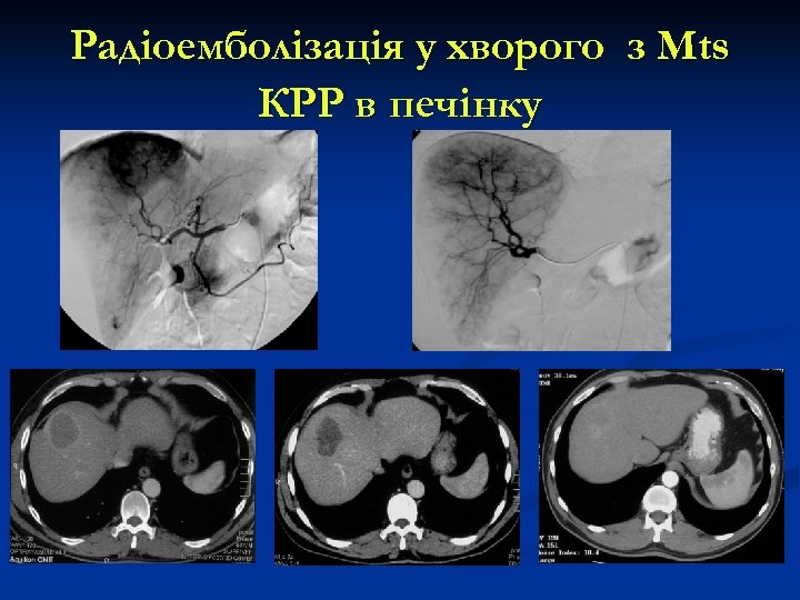 Радіоемболізація у хворого з Мts КРР в печінку До радиоэмболизации 1 мес 3 мес