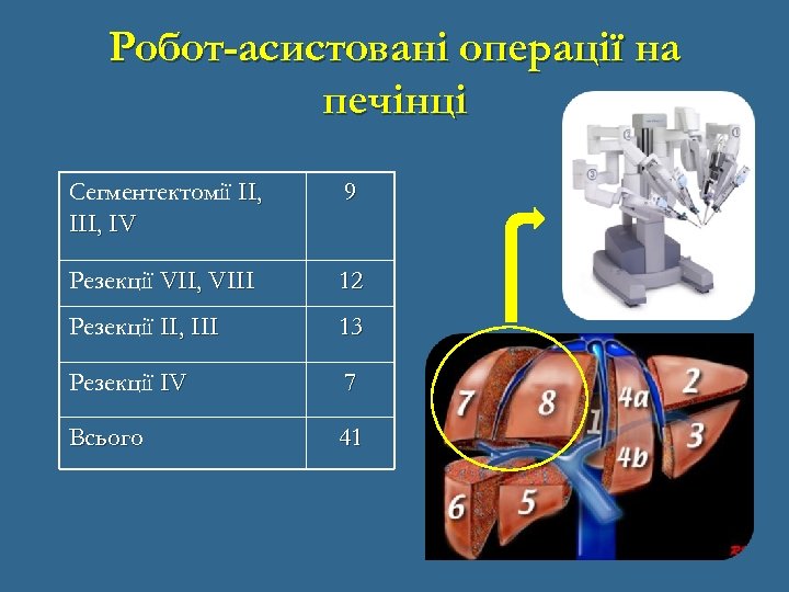 Робот-асистовані операції на печінці Сегментектомії II, IV 9 Резекції VII, VIII 12 Резекції II,