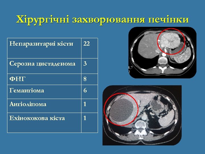 Хірургічні захворювання печінки Непаразитарні кісти 22 Серозна цистаденома 3 ФНГ 8 Гемангіома 6 Ангіоліпома