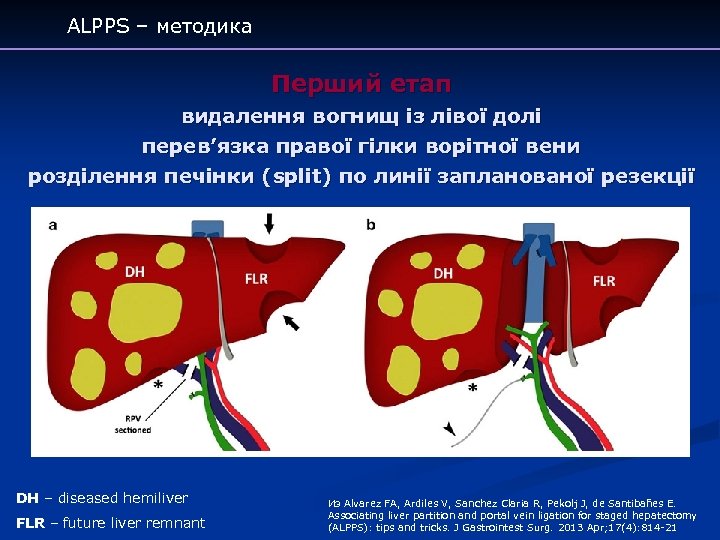 ALPPS – методика Перший етап видалення вогнищ із лівої долі перев’язка правої гілки ворітної