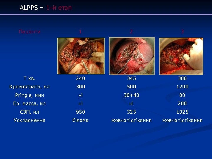 ALPPS – 1 -й етап Пацієнти 1 2 3 T хв. 240 345 300