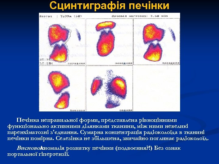 Сцинтиграфія печінки Печінка неправильної форми, представлена рівноцінними функціонально активними ділянками тканини, між ними невеликі