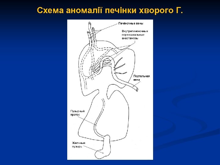 Схема аномалії печінки хворого Г. 