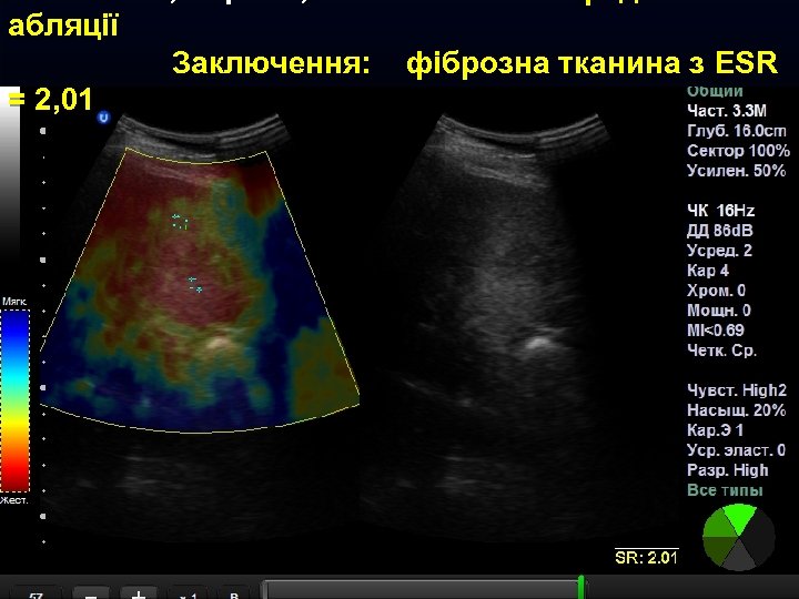 абляції Заключення: = 2, 01 фіброзна тканина з ESR 