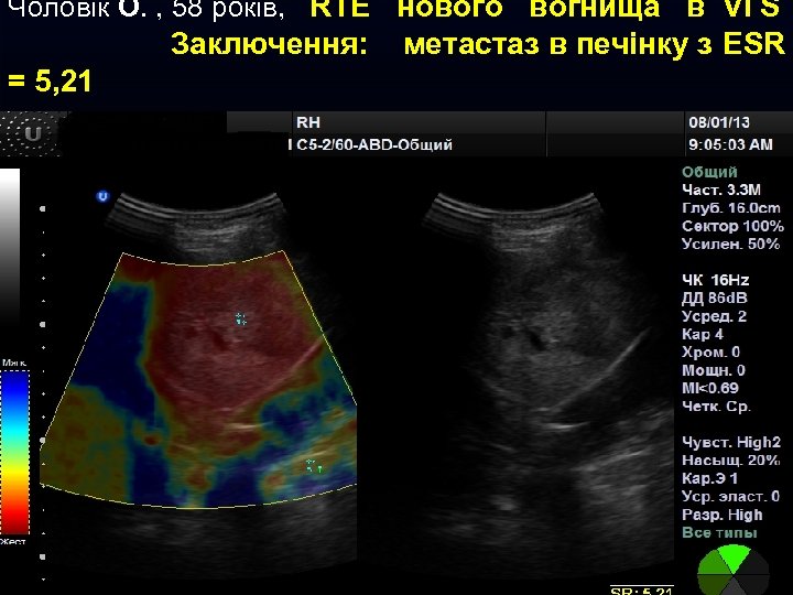 Чоловік О. , 58 років, RTE нового вогнища в VI S Заключення: = 5,