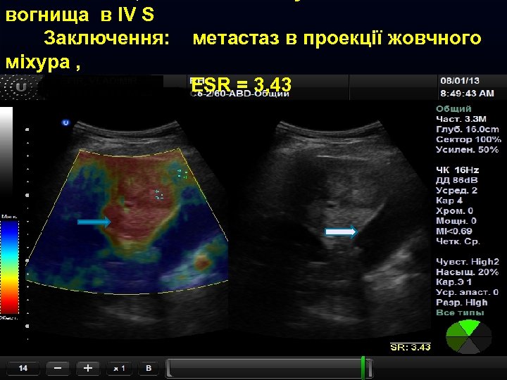 вогнища в IV S Заключення: міхура , метастаз в проекції жовчного ESR = 3,