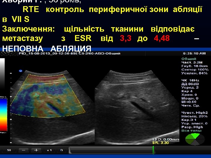 Хворий Г. , 56 років, RTE контроль периферичної зони абляції в VII S Заключення: