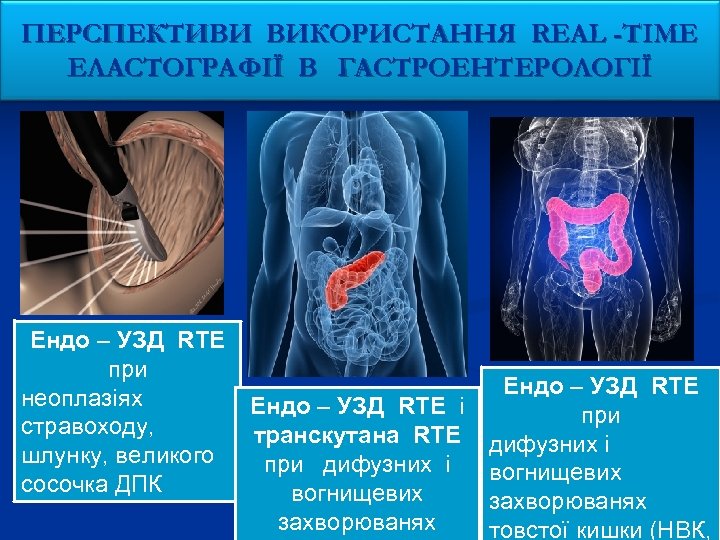 ПЕРСПЕКТИВИ ВИКОРИСТАННЯ REAL -TIME ЕЛАСТОГРАФІЇ В ГАСТРОЕНТЕРОЛОГІЇ Ендо – УЗД RTE при неоплазіях стравоходу,