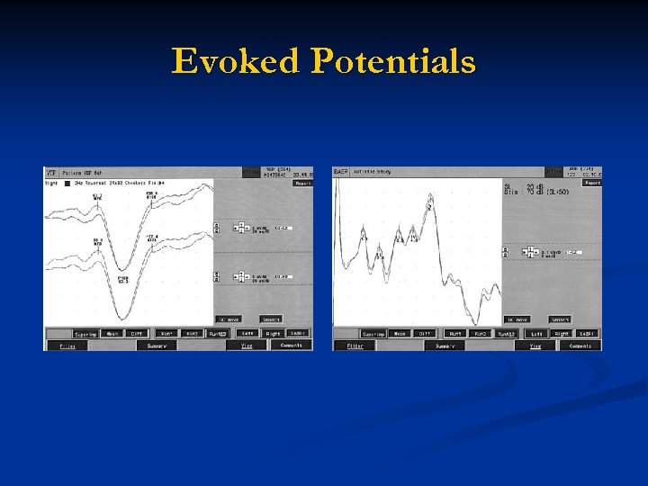 Evoked Potentials 