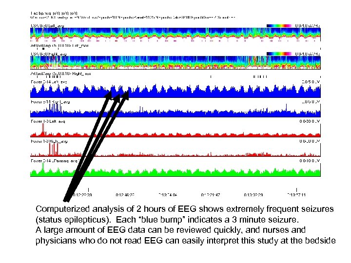 Computerized analysis of 2 hours of EEG shows extremely frequent seizures (status epilepticus). Each