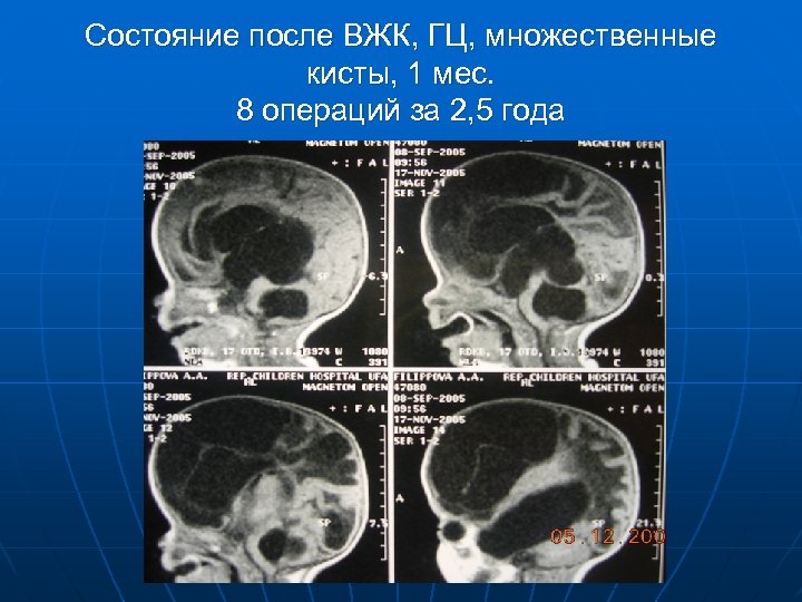 Состояние после ВЖК, ГЦ, множественные кисты, 1 мес. 8 операций за 2, 5 года