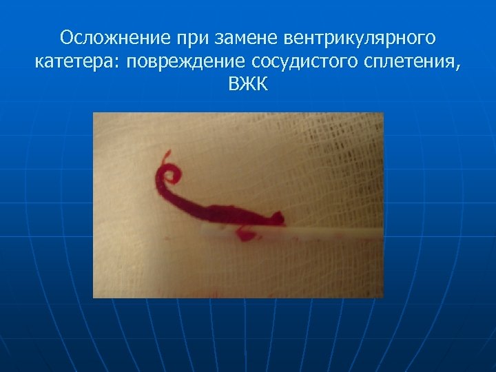 Осложнение при замене вентрикулярного катетера: повреждение сосудистого сплетения, ВЖК 