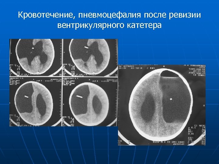 Кровотечение, пневмоцефалия после ревизии вентрикулярного катетера 