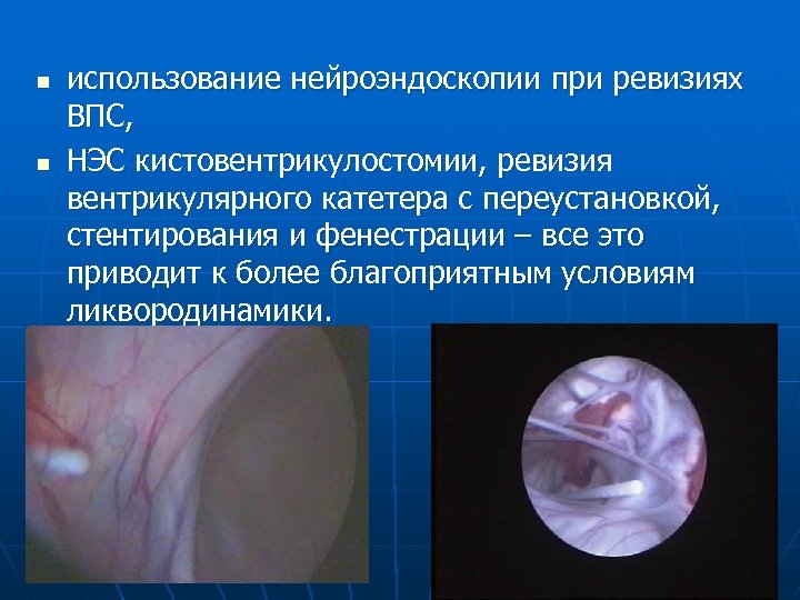 n n использование нейроэндоскопии при ревизиях ВПС, НЭС кистовентрикулостомии, ревизия вентрикулярного катетера с переустановкой,