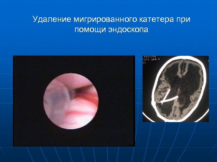 Удаление мигрированного катетера при помощи эндоскопа 