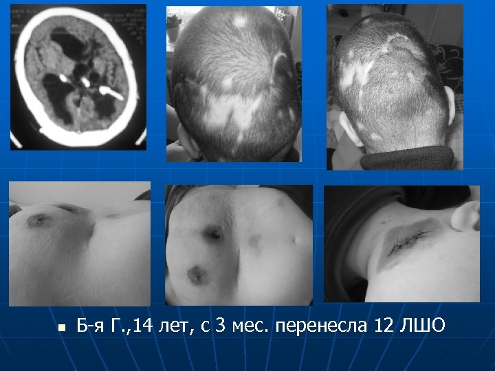 n Б-я Г. , 14 лет, с 3 мес. перенесла 12 ЛШО 