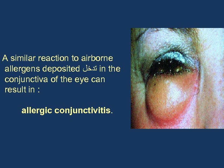 A similar reaction to airborne allergens deposited ﺗﺪﺧﻞ in the conjunctiva of the eye