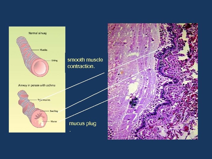 smooth muscle contraction. mucus plug. 