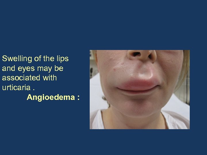 Swelling of the lips and eyes may be associated with urticaria. Angioedema : 