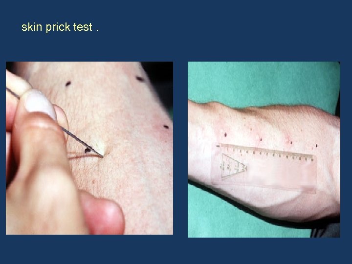 skin prick test. skin prick test 