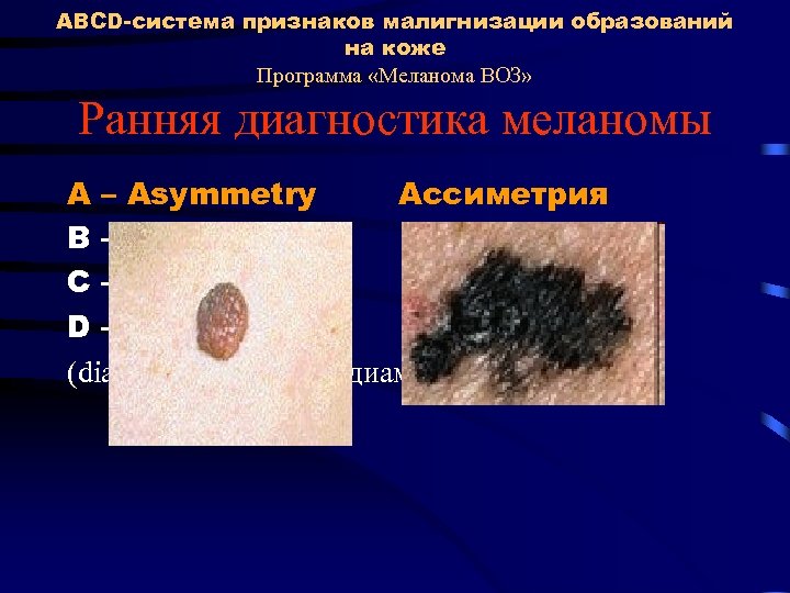 ABCD-система признаков малигнизации образований на коже Программа «Меланома ВОЗ» Ранняя диагностика меланомы A –