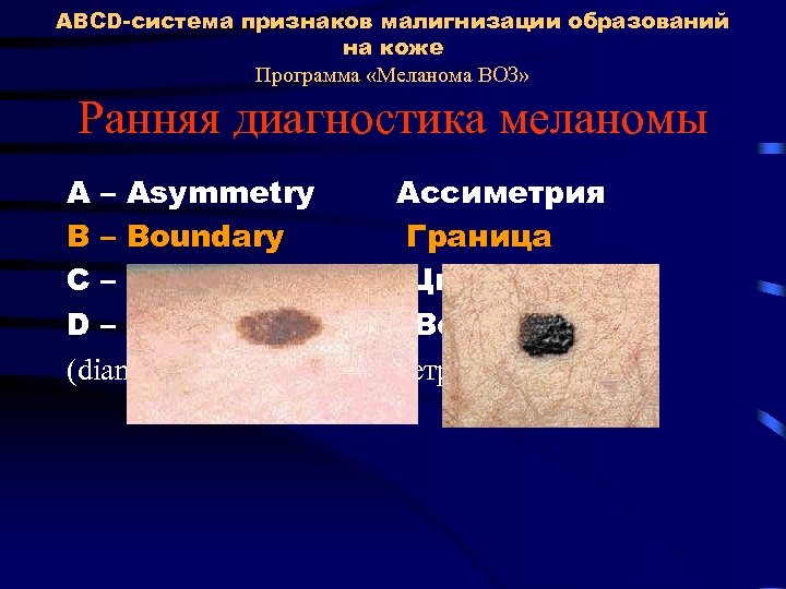 ABCD-система признаков малигнизации образований на коже Программа «Меланома ВОЗ» Ранняя диагностика меланомы A –