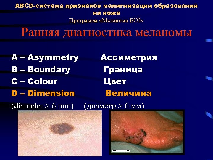 ABCD-система признаков малигнизации образований на коже Программа «Меланома ВОЗ» Ранняя диагностика меланомы A –