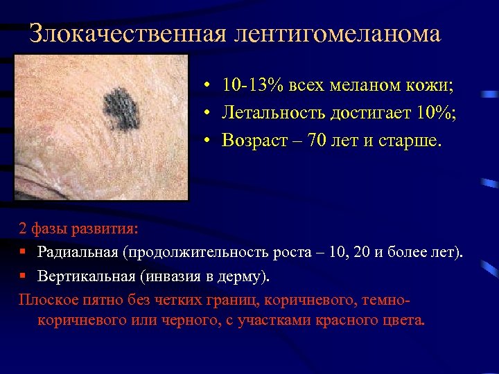 Злокачественная лентигомеланома • 10 -13% всех меланом кожи; • Летальность достигает 10%; • Возраст